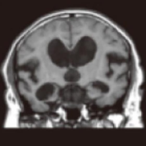 MRIまたはCTの脳画像検査