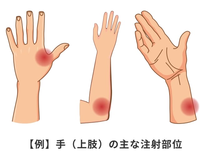 【例】手（上肢）の主な注射部位