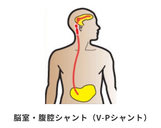 脳室・腹腔シャント（V-Pシャント）